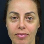 Blepharoplasty Before & After Patient #1361