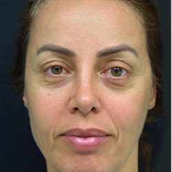 Blepharoplasty Before & After Patient #1361