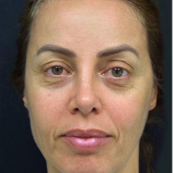 Blepharoplasty Before & After Patient #1361