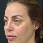Blepharoplasty Before & After Patient #1361