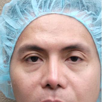 Blepharoplasty Before & After Patient #1362