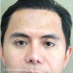 Blepharoplasty Before & After Patient #1362