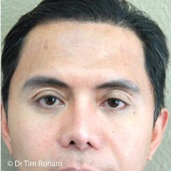 Blepharoplasty Before & After Patient #1362