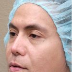 Blepharoplasty Before & After Patient #1362