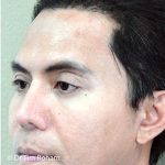 Blepharoplasty Before & After Patient #1362