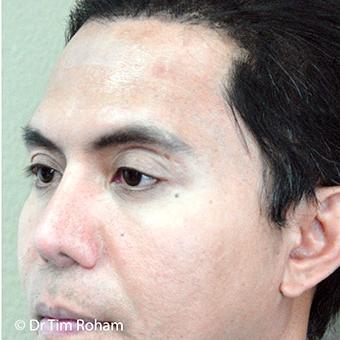 Blepharoplasty Before & After Patient #1362