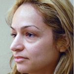 Blepharoplasty Before & After Patient #1363