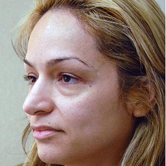 Blepharoplasty Before & After Patient #1363