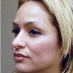 Blepharoplasty Before & After Patient #1363