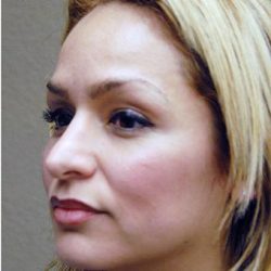 Blepharoplasty Before & After Patient #1363