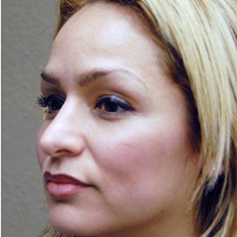 Blepharoplasty Before & After Patient #1363