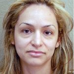 Blepharoplasty Before & After Patient #1363