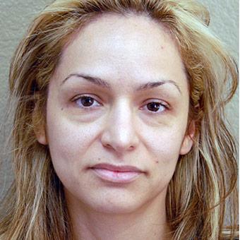 Blepharoplasty Before & After Patient #1363
