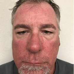 Blepharoplasty Before & After Patient #1340