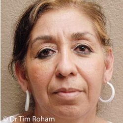 Blepharoplasty Before & After Patient #1364