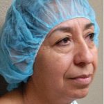 Blepharoplasty Before & After Patient #1364