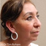 Blepharoplasty Before & After Patient #1364