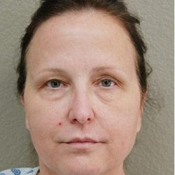 Blepharoplasty Before & After Patient #1366