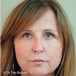 Blepharoplasty Before & After Patient #1366
