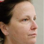 Blepharoplasty Before & After Patient #1366