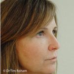 Blepharoplasty Before & After Patient #1366