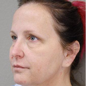 Blepharoplasty Before & After Patient #1366