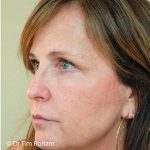 Blepharoplasty Before & After Patient #1366