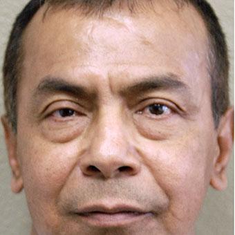 Blepharoplasty Before & After Patient #1367