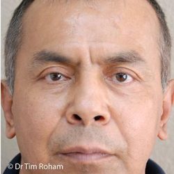 Blepharoplasty Before & After Patient #1367