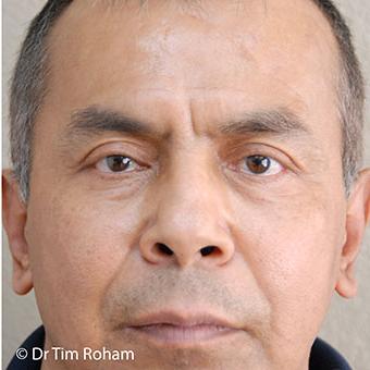 Blepharoplasty Before & After Patient #1367