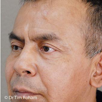 Blepharoplasty Before & After Patient #1367