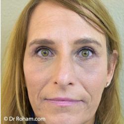 Blepharoplasty Before & After Patient #1368