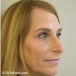 Blepharoplasty Before & After Patient #1368