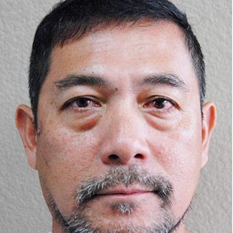 Blepharoplasty Before & After Patient #1369