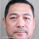 Blepharoplasty Before & After Patient #1369