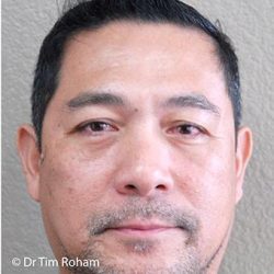 Blepharoplasty Before & After Patient #1369