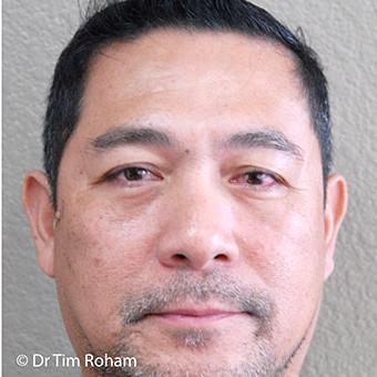 Blepharoplasty Before & After Patient #1369