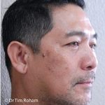Blepharoplasty Before & After Patient #1369
