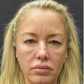 Blepharoplasty Before & After Patient #1370