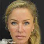 Blepharoplasty Before & After Patient #1370
