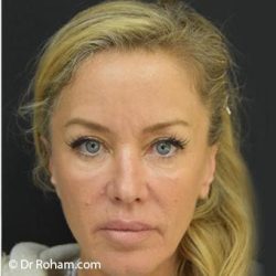Blepharoplasty Before & After Patient #1370