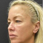 Blepharoplasty Before & After Patient #1370