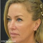Blepharoplasty Before & After Patient #1370
