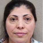 Blepharoplasty Before & After Patient #1371