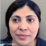 Blepharoplasty Before & After Patient #1371