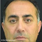 Blepharoplasty Before & After Patient #1372