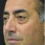 Blepharoplasty Before & After Patient #1372
