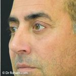 Blepharoplasty Before & After Patient #1372