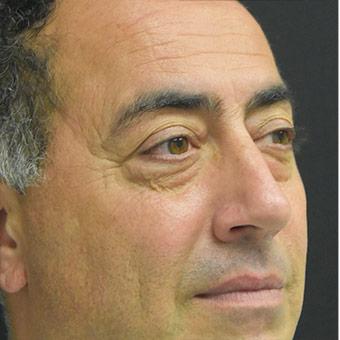 Blepharoplasty Before & After Patient #1372