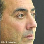 Blepharoplasty Before & After Patient #1372